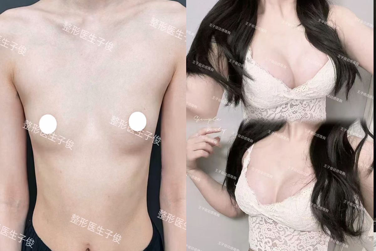 Breast lift surgery