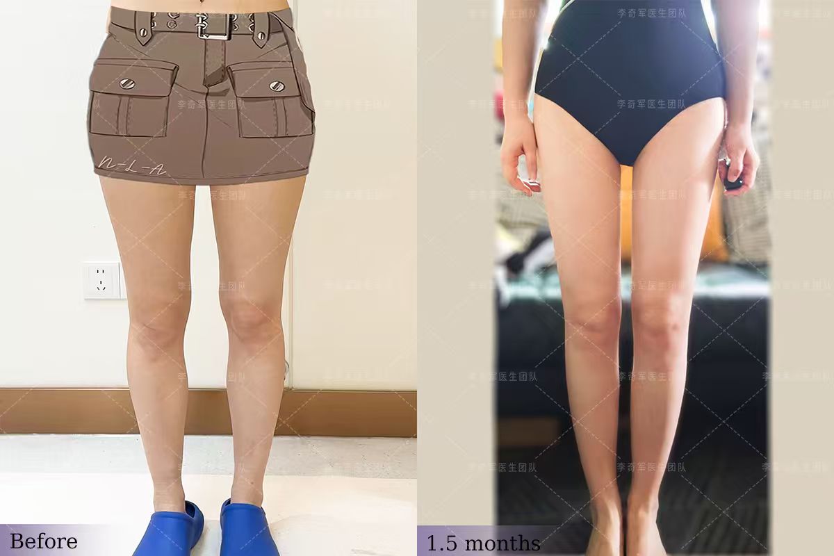 N-L-A straight leg surgery
