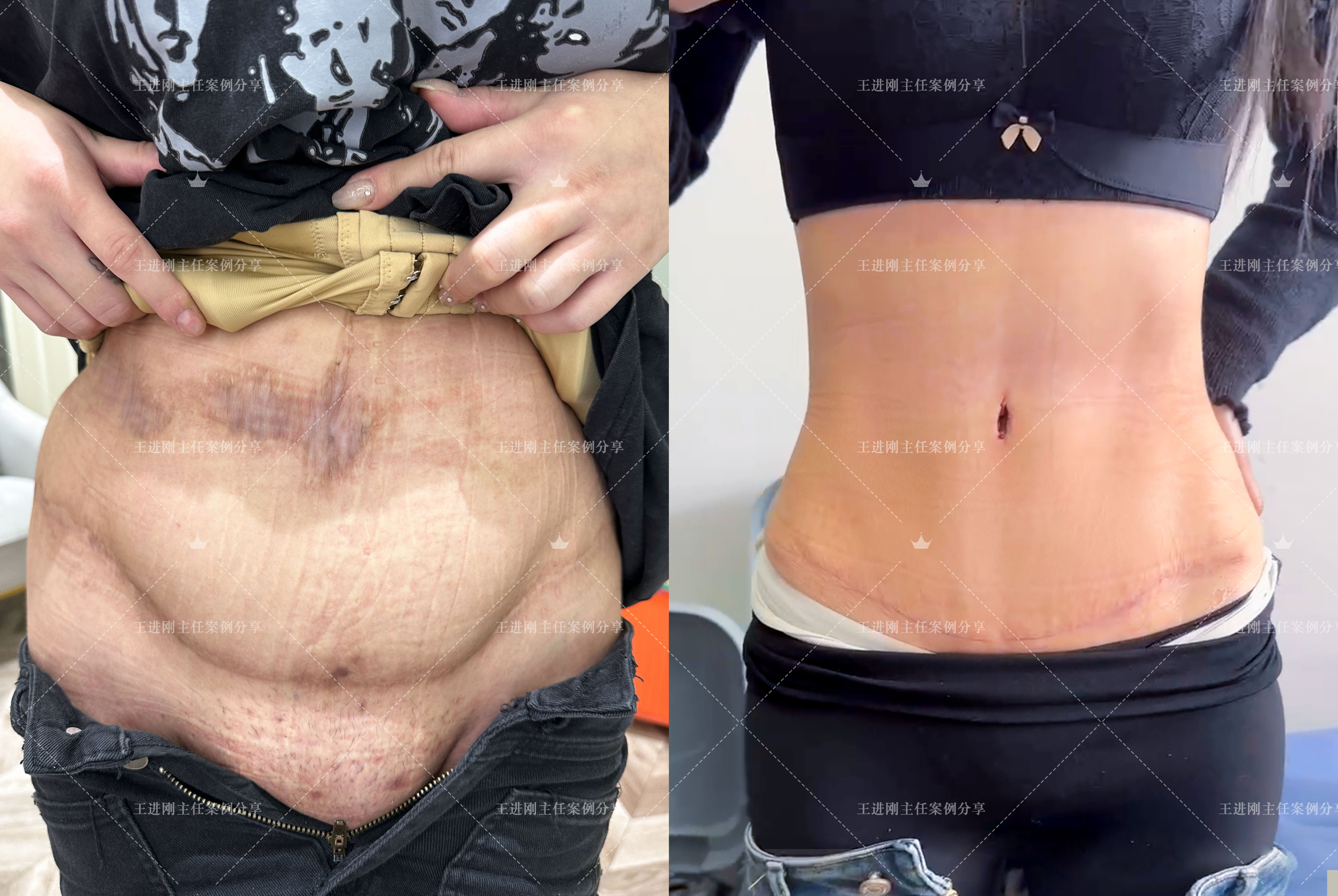 Ultra-low high tension abdominoplasty